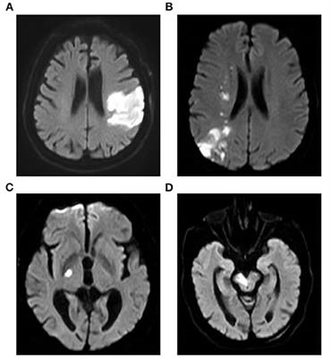 Clinical Utility of the Serum Level of Lipoprotein-Related Phospholipase A2 in Acute Ischemic Stroke With Cerebral Artery Stenosis